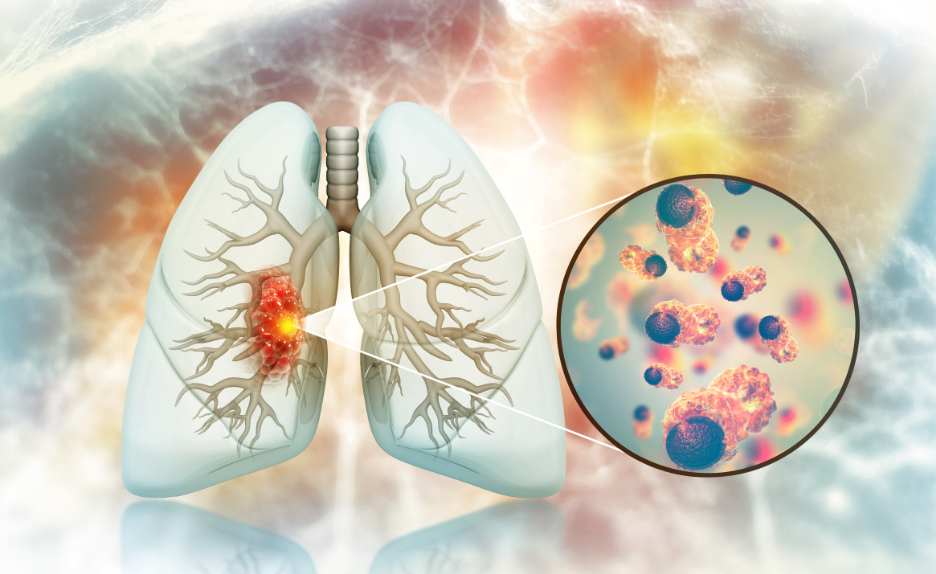 为什么肺癌一经确诊，就是晚期？肺癌初期症状有哪些？如何早发现？