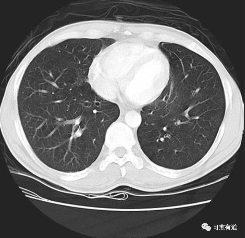 揭秘 “肺鳞癌” 特点以及如何选择最佳检测和治疗方案？