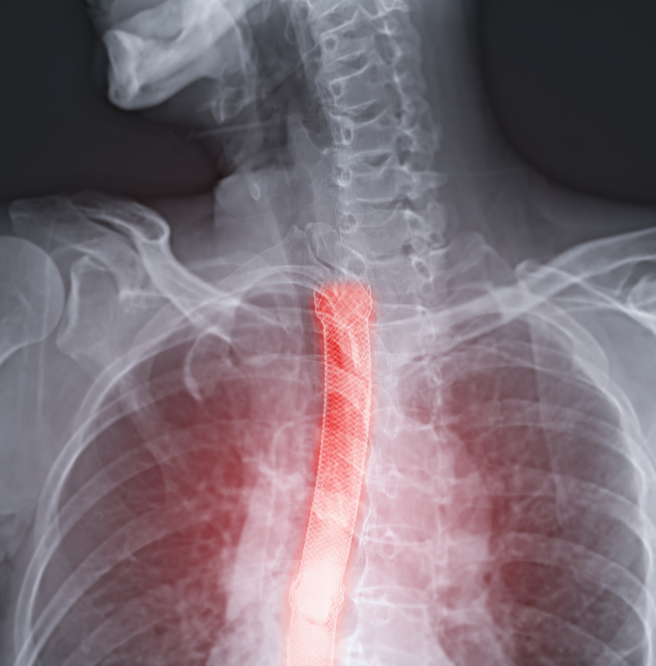 食管癌X光片