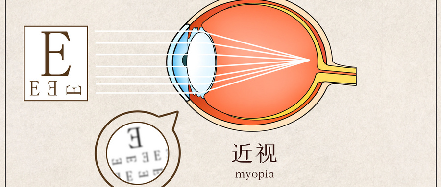 Vuity：每日两次使用的1.25%盐酸毛果芸香碱眼用溶液，显著改善老年性近视（老花眼）症状