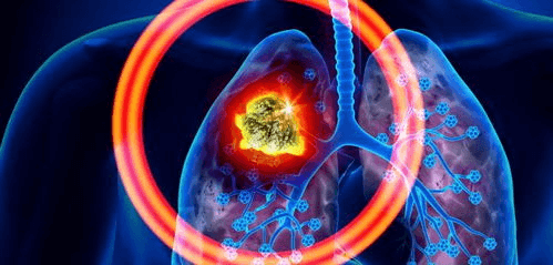 2023年肺癌治疗领域：中美两国上市新药全面盘点！