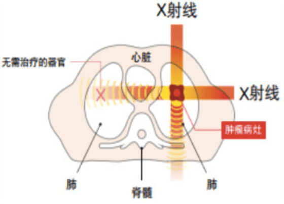 日本重离子治疗