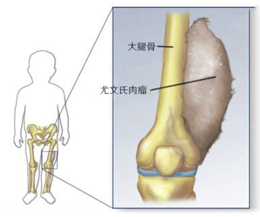 腿部尤文肉瘤赴日手术治疗