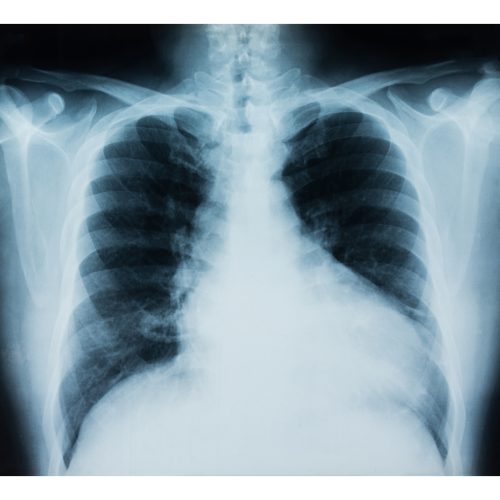 关于小细胞肺癌，你必须要了解的几个事实