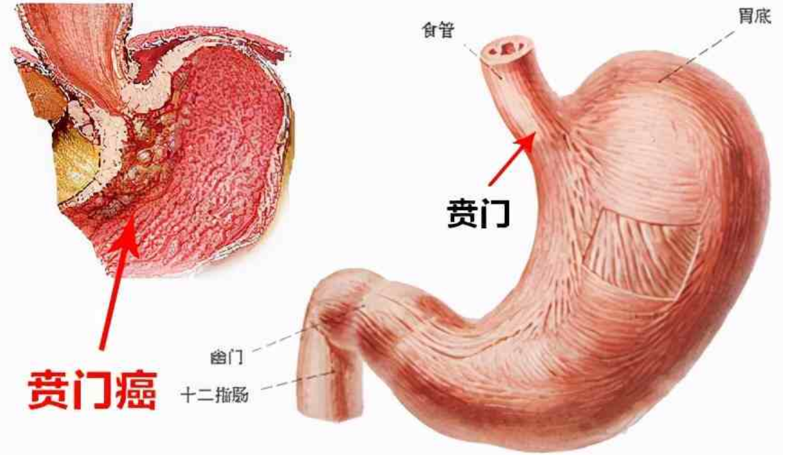 贲门癌