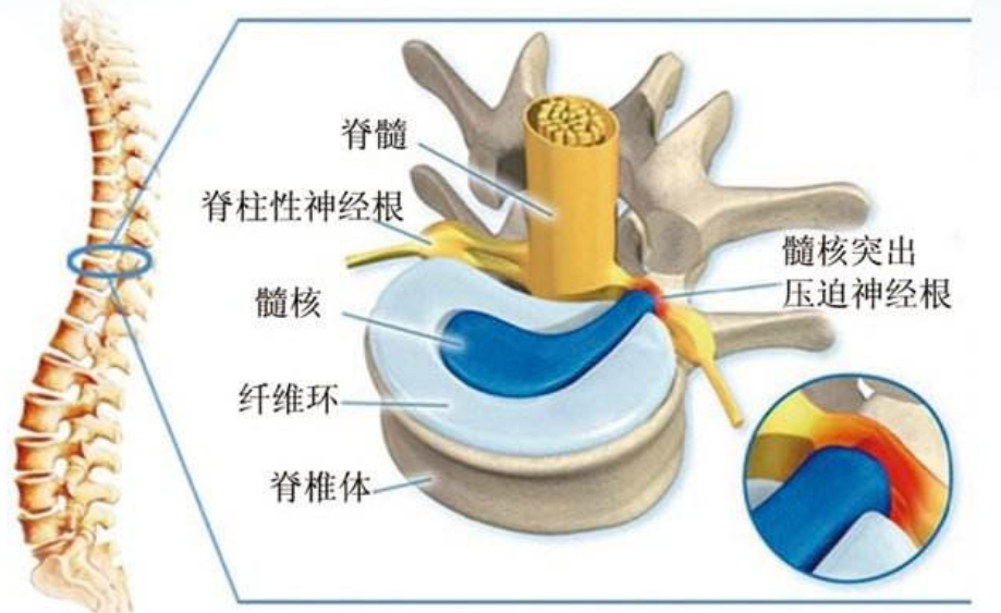 腰椎间盘突出