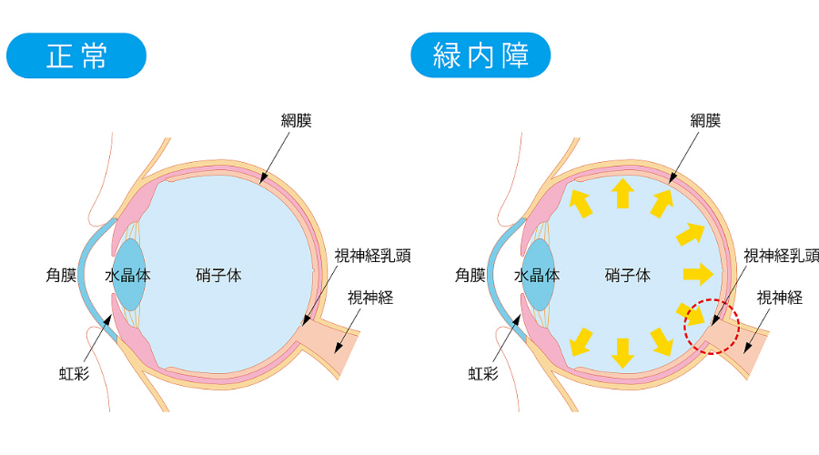 青光眼