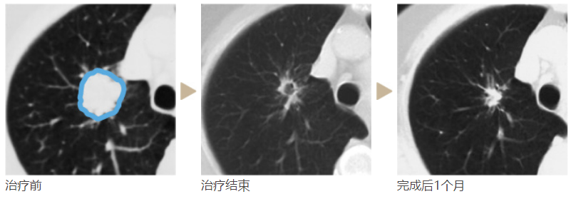 哪些类型的肺癌患者适合进行质子治疗？