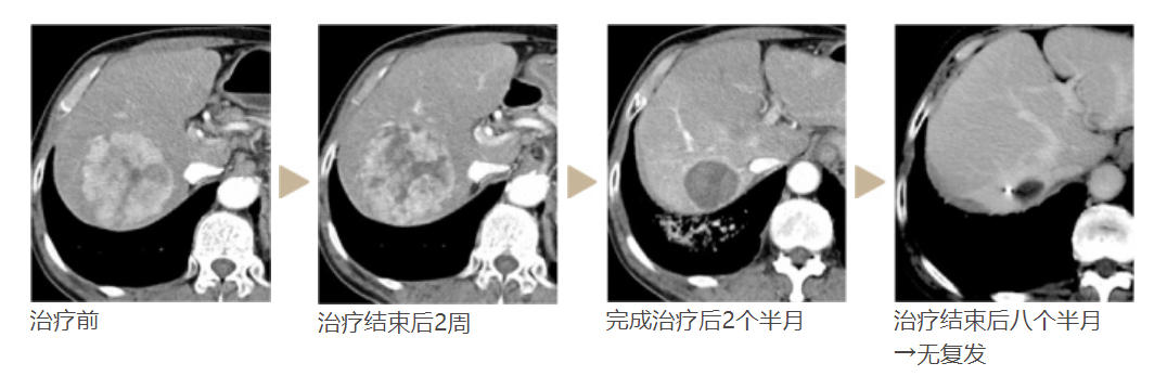 癌症CT