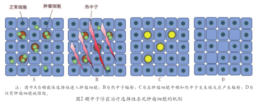 硼中子治疗