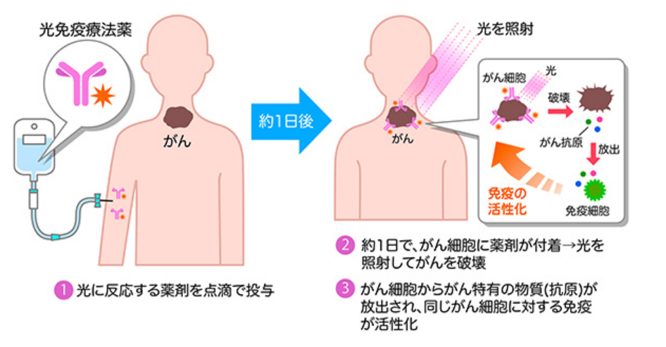 癌症最新疗法 || “光免疫疗法”一种新型非侵入性癌症治疗方法，为癌症患者带来新希望！