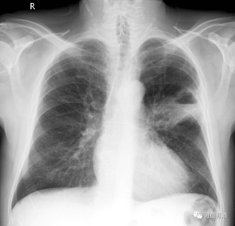 肺鳞癌X光片