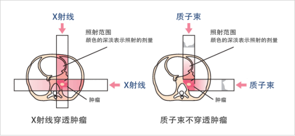 [日本案例]质子治疗-室管膜瘤患者，赴日就医