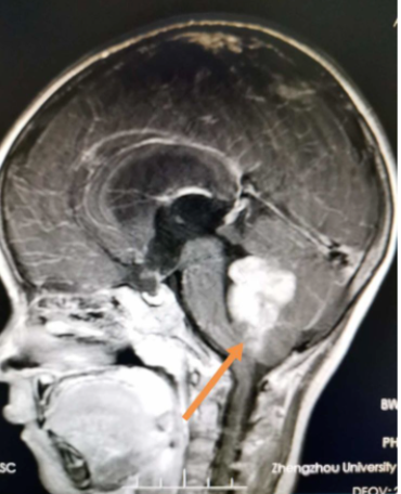 质子治疗儿童髓母细胞瘤的效果如何？一文带你了解