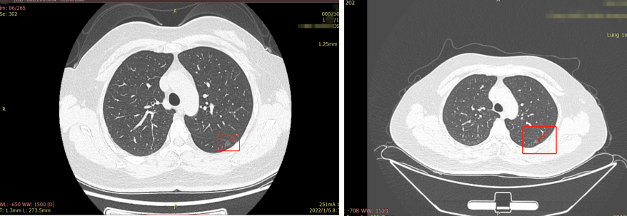 [案例分享]再次体检发现，肺结节增多了，长大了？(二)