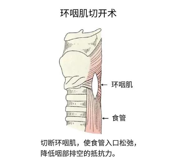 环咽肌切开术