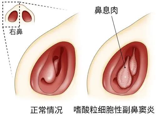 嗜酸粒细胞性鼻窦炎