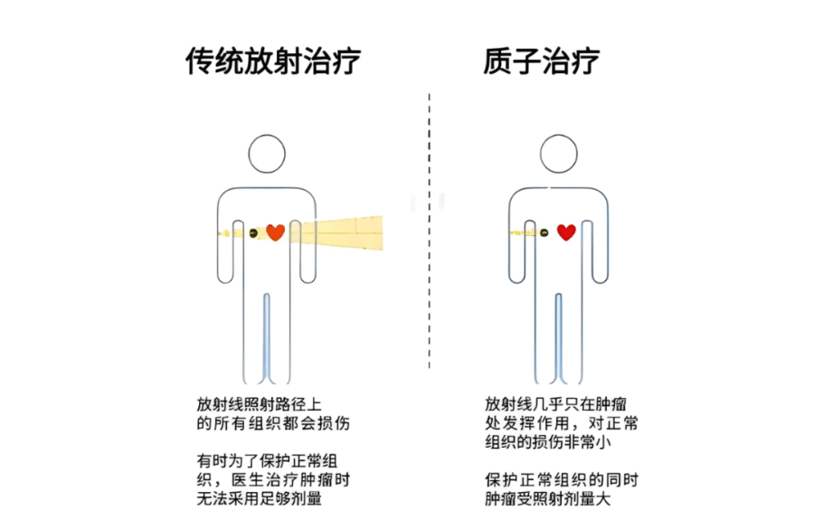 日本质子治疗儿童肿瘤：突破传统治疗困境的新希望