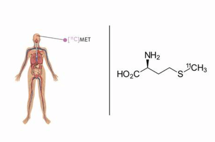 脑部蛋氨酸PET显像：深度探索大脑奥秘
