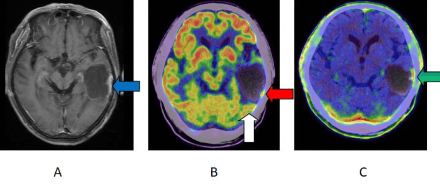 脑部蛋氨酸PET显像：深度探索大脑奥秘