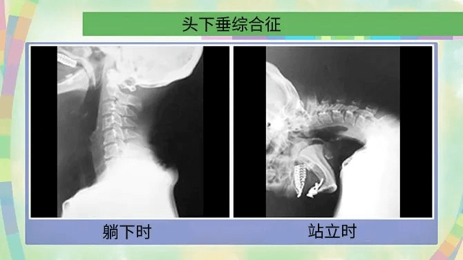 头下垂综合征