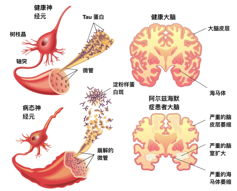 阿尔茨海默症的治疗新药｜仑卡奈单抗(Lecanemab）