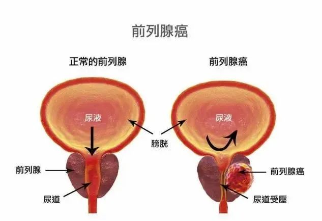 前列腺癌赴日质子线治疗：享受先进的医疗技术