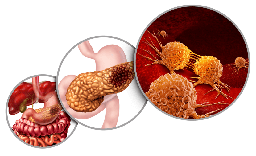 mRNA疫苗在胰腺癌治疗中的研究进展