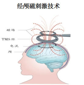 药物抵抗性抑郁症的新希望：经颅磁刺激疗法（rTMS）的崛起