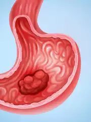 Zolbetuximab：开启晚期胃癌靶向治疗新篇章！显著延长患者生存期！