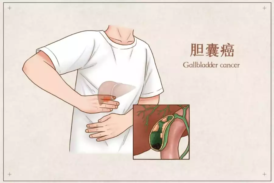 可愈有道_日本看病_胆囊癌