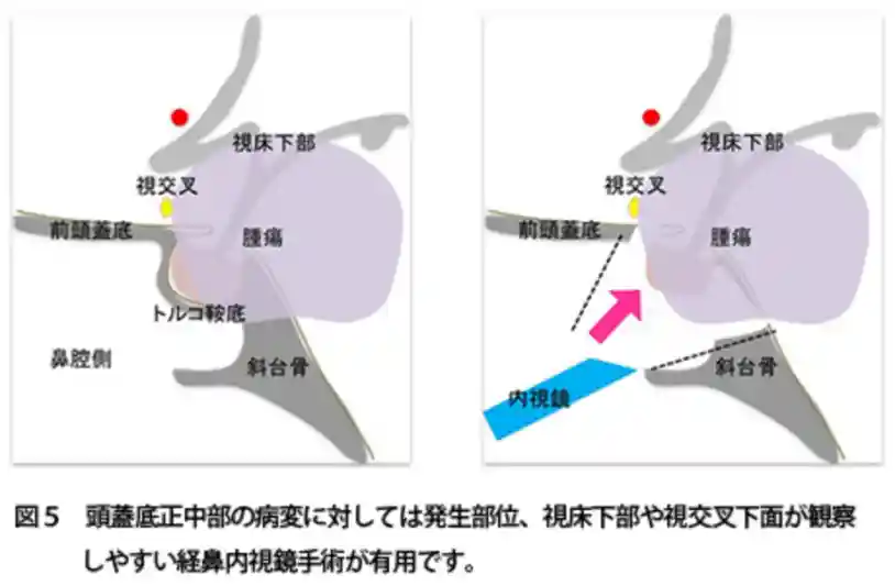 内窥镜微创颅底手术 内窥镜微创颅底手术