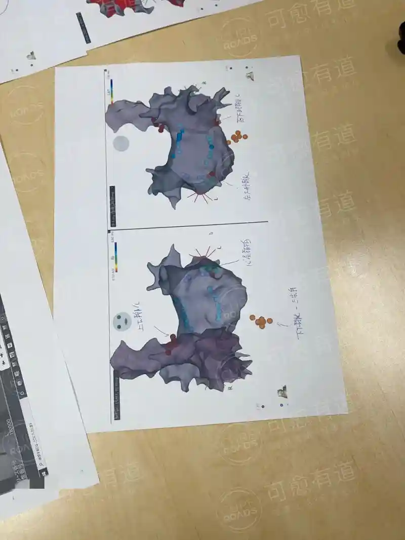 房颤术后复发