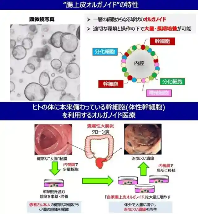 界首例自体肠道上皮类器官移植 界首例自体肠道上皮类器官移植
