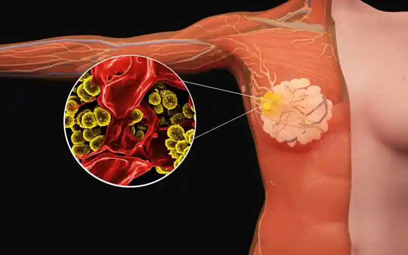 可愈有道_出国看病_乳腺癌手术有了&ldquo;实时导航&rdquo;：FDA批准首款AI成像设备，术中就知道切没切干净