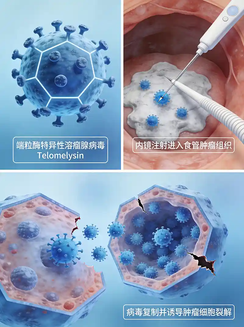 内镜引导下Telomelysin瘤内注射治疗食管癌示意图