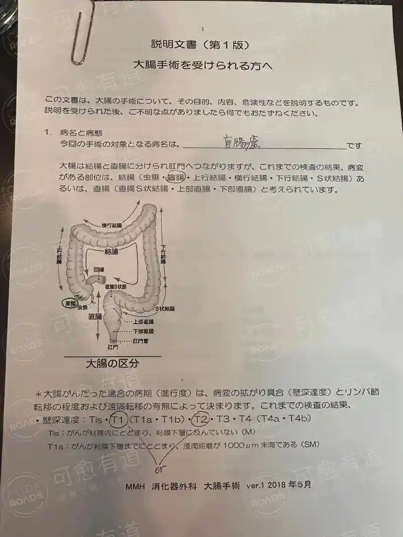 肠癌手术说明 肠癌手术说明