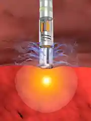 可愈有道_出国看病_FDA批准强生双能量心脏消融平台THERMOCOOL SMARTTOUCH SF